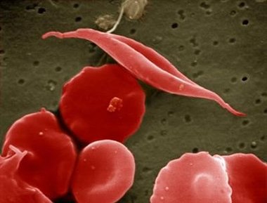 Sickle Cell Disease